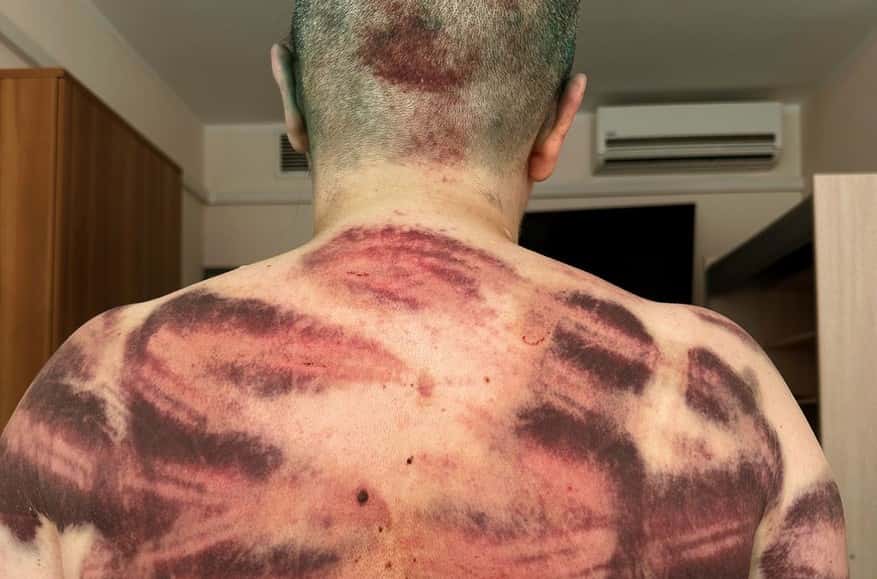 Fractures, bruises, and traumatic brain injury: Moscow clinic examines journalist Elena Milashina, victim of July 4 assault in Chechnya